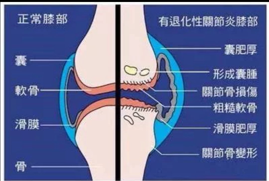 所谓髌骨的软骨,是指髌骨接触股骨的一面,表面非常光滑,由一层软骨