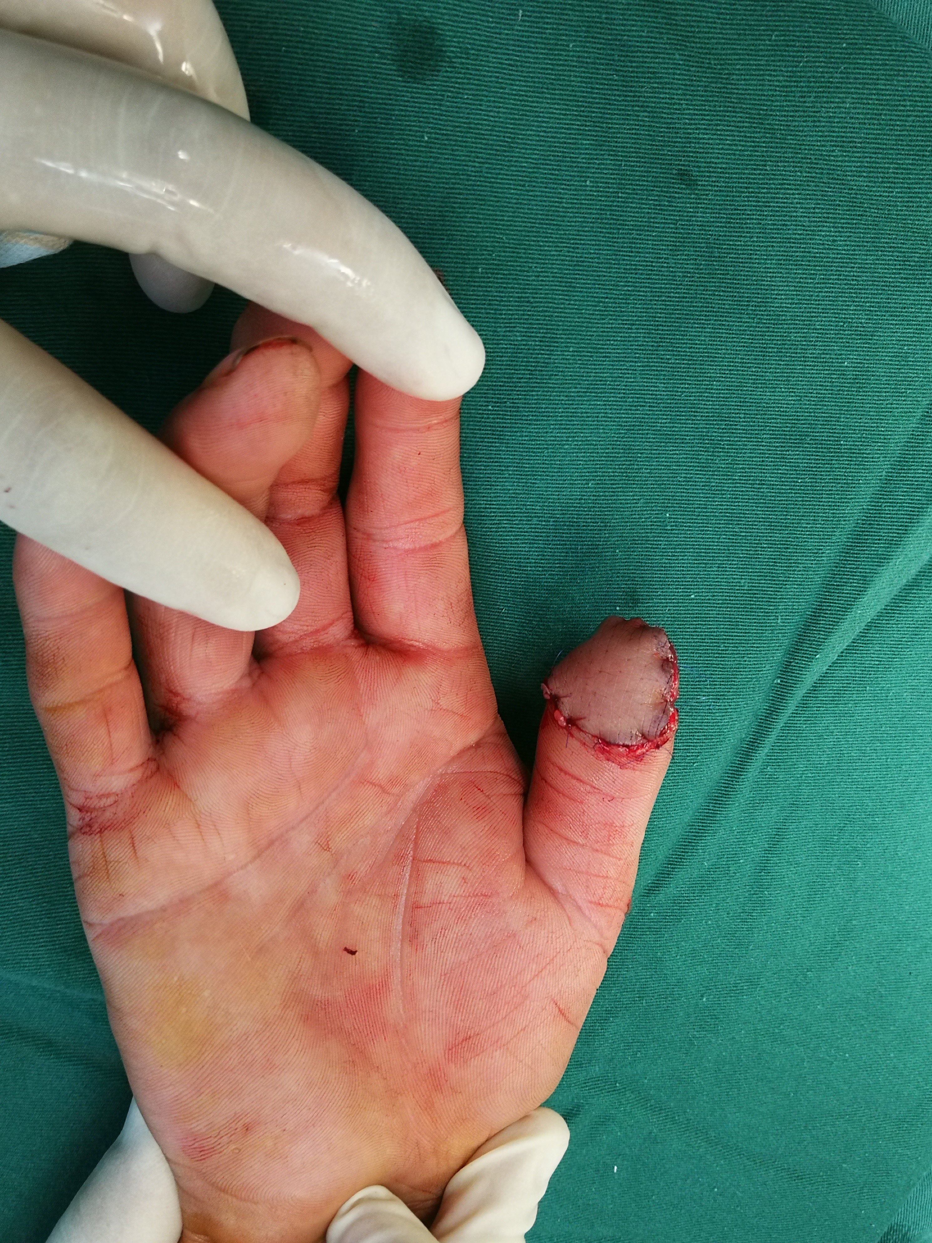 拇指尺背侧的供区能够直接缝合,损伤较小.作者认为这种方法是拇指指腹