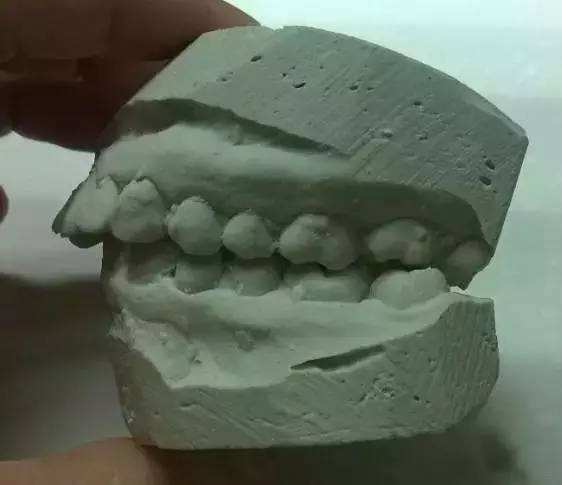 由于骨性龅牙多是因为骨突所造成的,在临床上主要表现为:开唇露齿,在