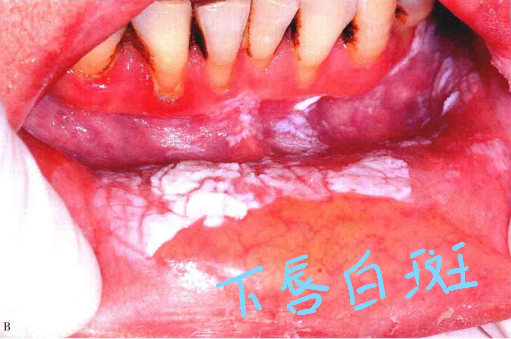 口腔黏膜白斑的图文介绍