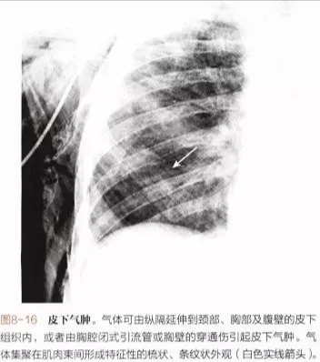 什么是胸部皮下气肿