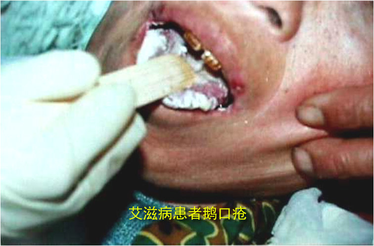与艾滋病患者共进晚餐