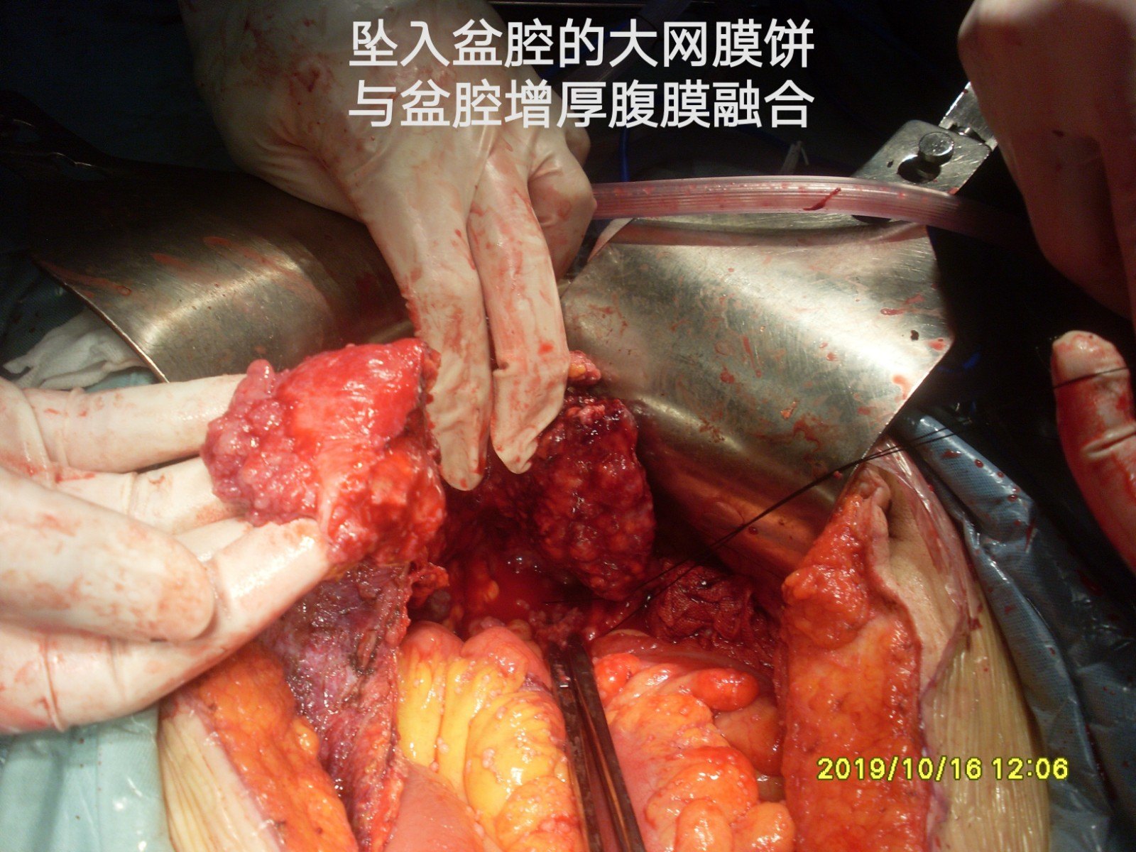 病例133腹膜转移病理为浆液癌是卵巢癌还是原发性腹膜癌