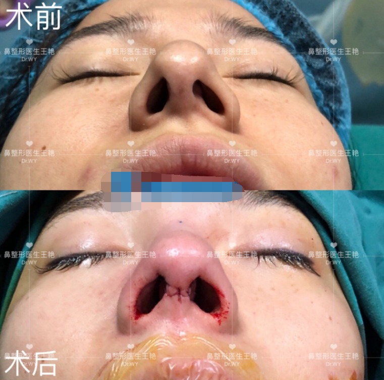 还有一个情况就是假体包膜挛缩,常见于单纯硅胶假体中,在隆鼻手术中