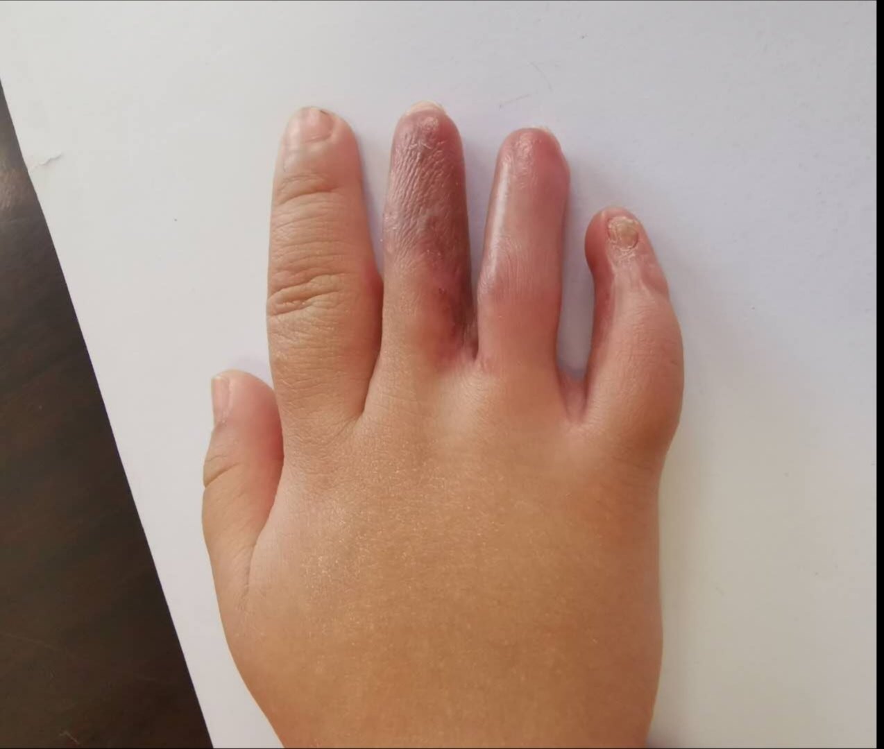 幼儿短指畸形延长术