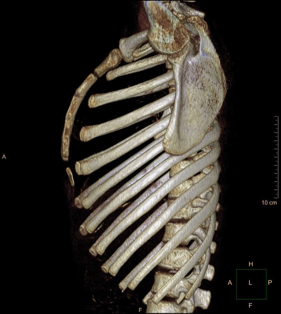 ct三位重建显示向前突出的弧形胸骨