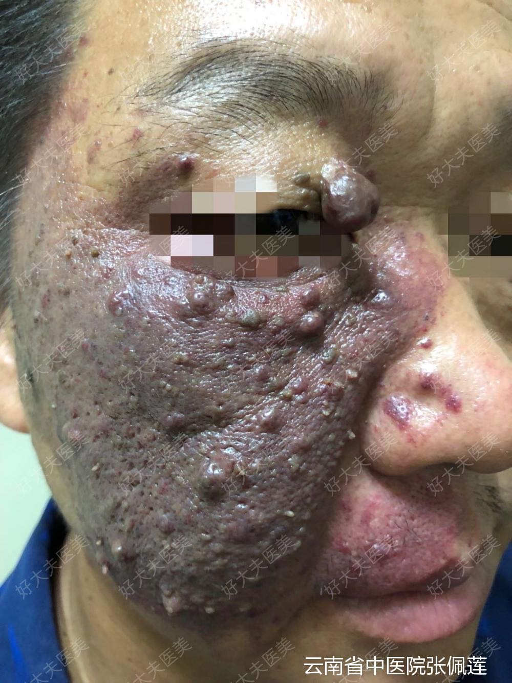 鲜红斑痣是如何分型的