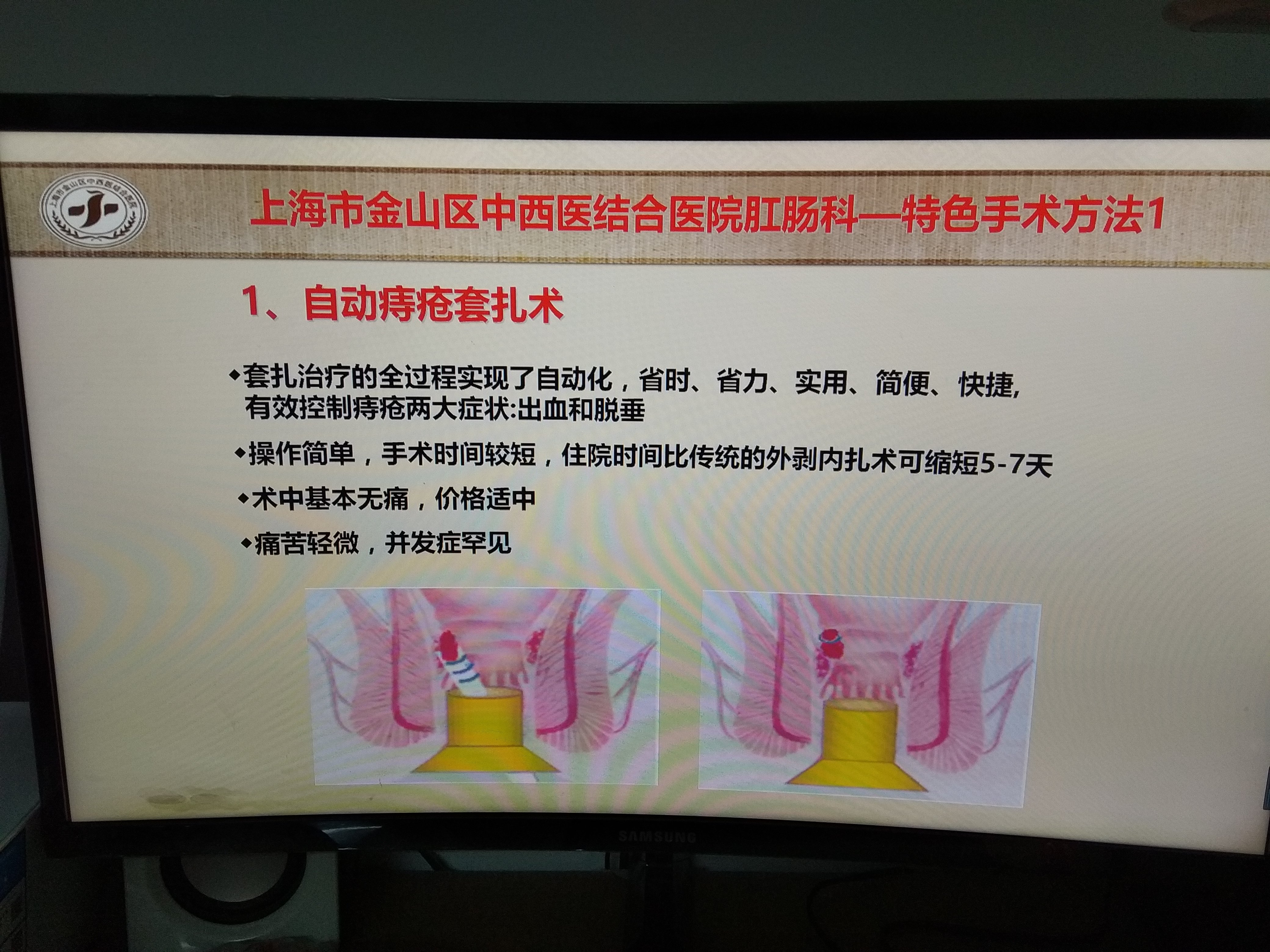 上海市金山区中西医结合医院肛肠科特色手术方法1---自动痔疮套扎术