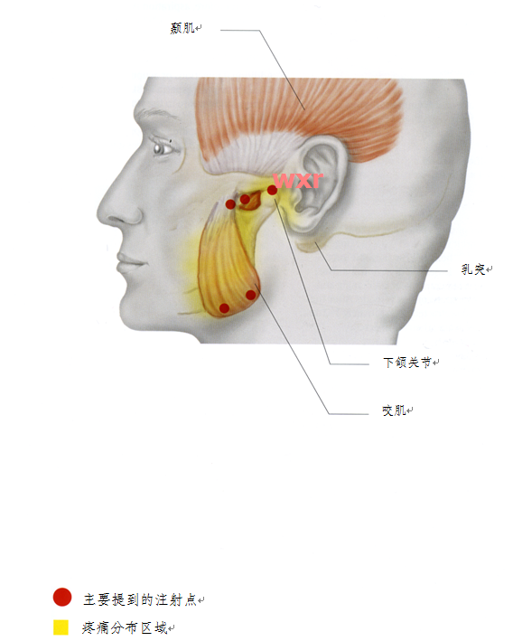 上颌关节的两个注射点位于咬肌肌腹水平(即患者咬紧牙关时鼓起的位置)
