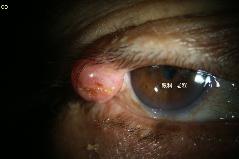 皮脂腺癌,表现为浸润睑缘的单发性眼睑结节