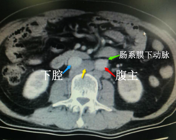 ct显示肠系膜下动脉平面,腹主与下腔之间no.