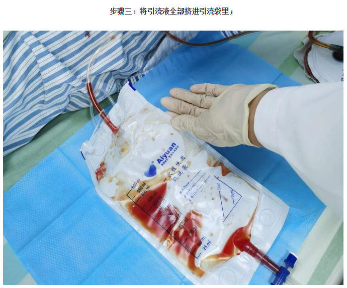 乳腺癌术后患者带管居家护理