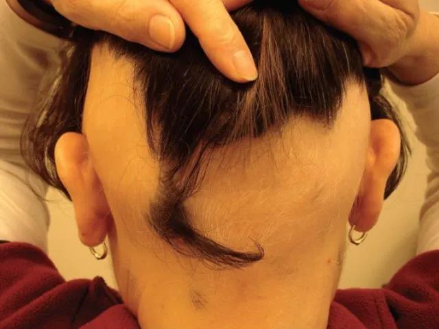 行性脱发(ophiasis)典型地沿枕后发际线呈带状蜿蜒扩展至双颞部(见图