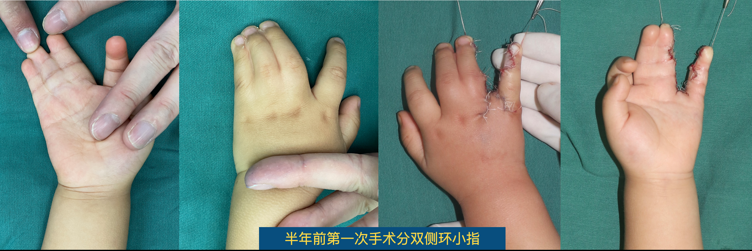 杨光 > 并指多指术后弹力加压指套控制去瘢痕      上周手术的并指