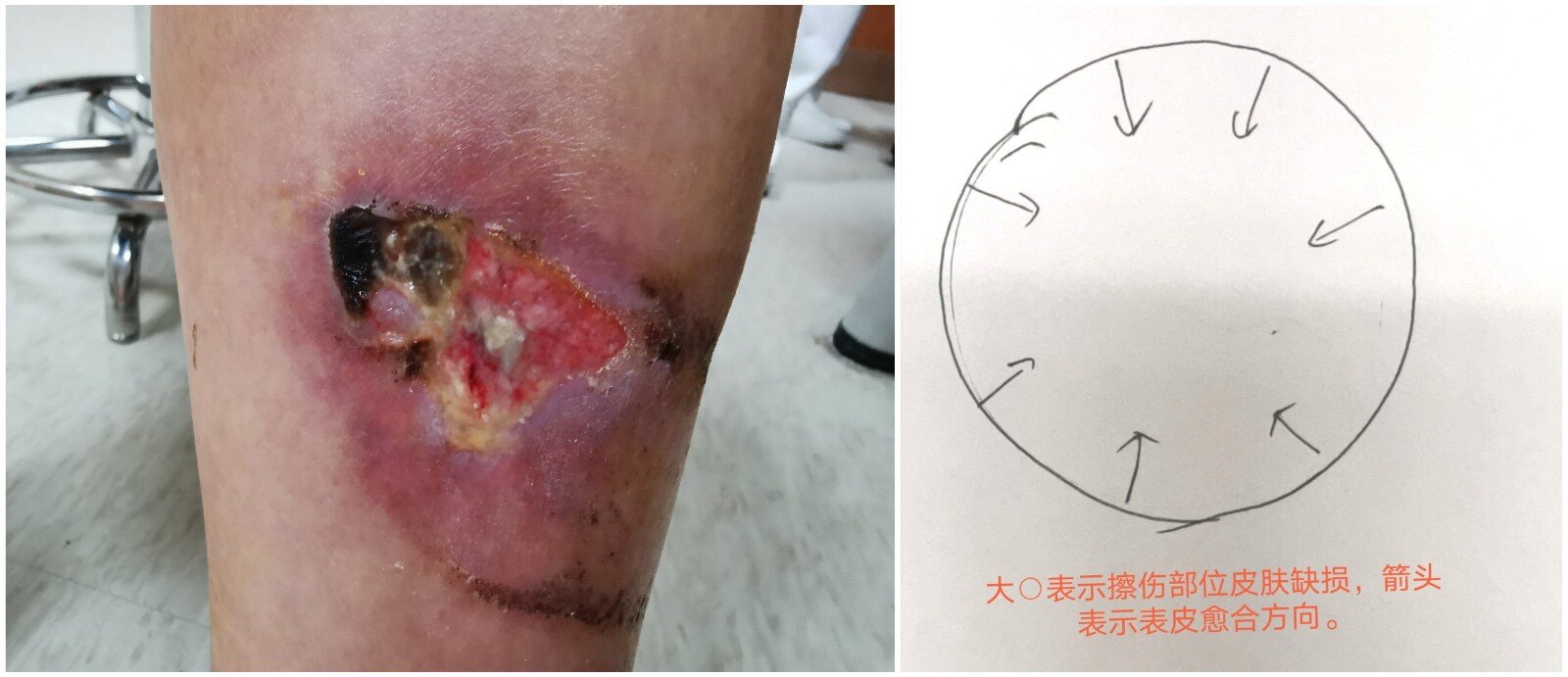 愈合只能靠周围皮肤向中心生长(如下图),不仅愈合慢,而且因真皮层被