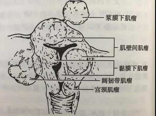 此外还有长在特殊部位的肌瘤如宫颈肌瘤,阔韧带肌瘤等.