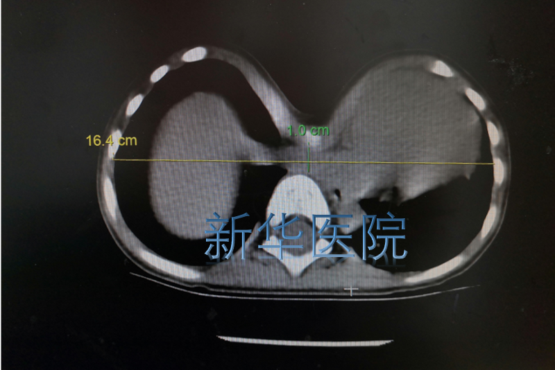 漏斗胸,前胸壁距离脊柱仅仅1cm,也就是我们老百姓所说的"前心贴后背"