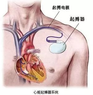 了解起搏器及术后注意事项_心脏起搏器植入术_心脏器