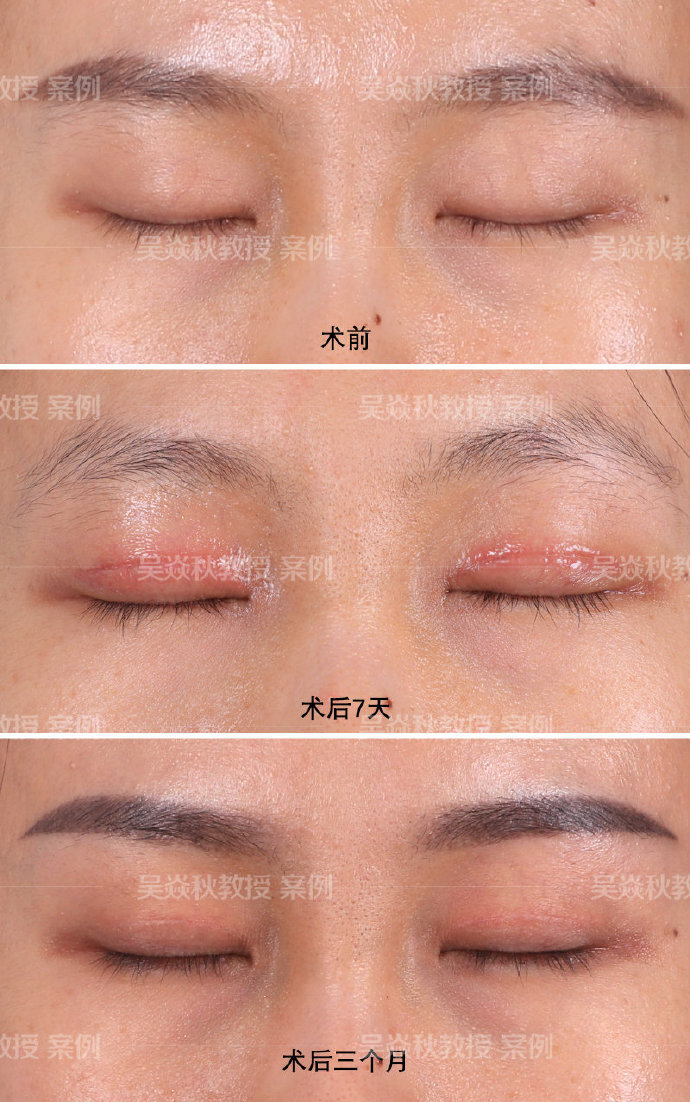 切开双眼皮术后疤痕恢复过程图
