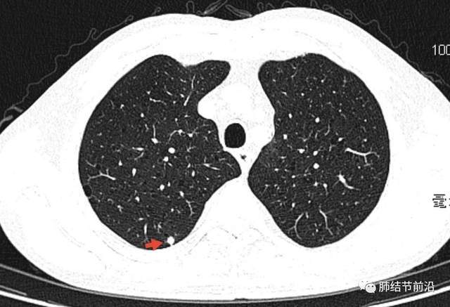 5mm的微小实性结节竟是恶性程度最高的肺癌