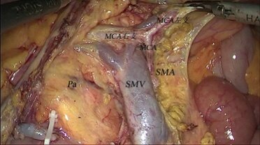 上面是一张我们团队做的直肠癌患者的血管根部淋巴清扫,在看一张我们