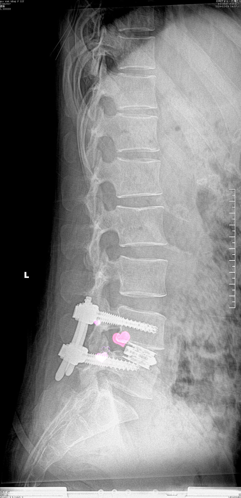 术后腰椎侧位片:l5椎弓根螺钉稍短,位置好.融合器位置佳.