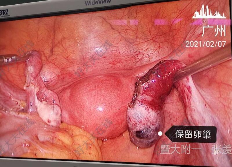 切除坏死的右侧输卵管和卵巢囊肿,保留右侧卵巢,希望右侧卵巢能恢复