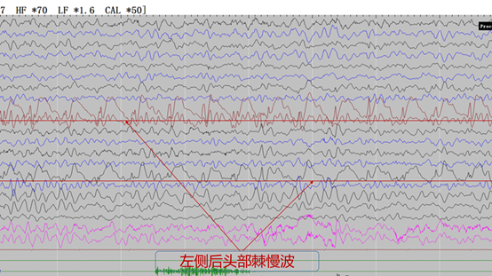 枕叶癫痫都可以手术治疗吗