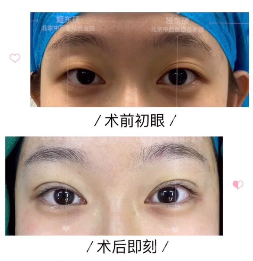 什么样的眼睛适合做微创三点双眼皮