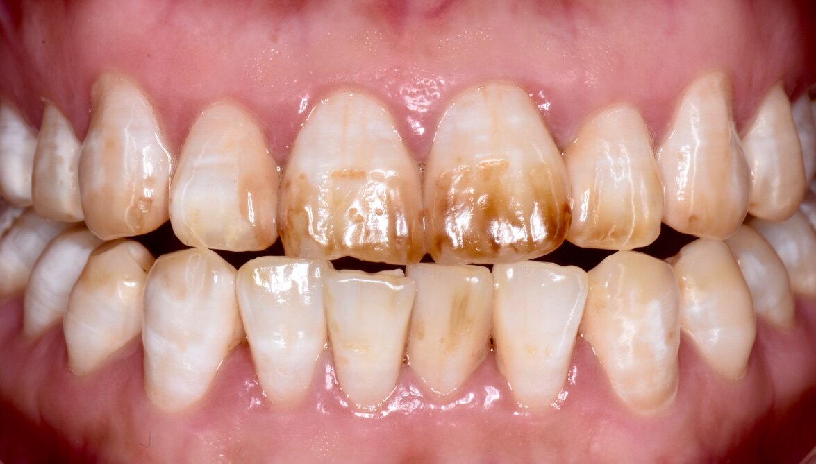 由于饮用水中含氟量过高导致牙齿发育过程中矿化异常所引起的牙齿内源