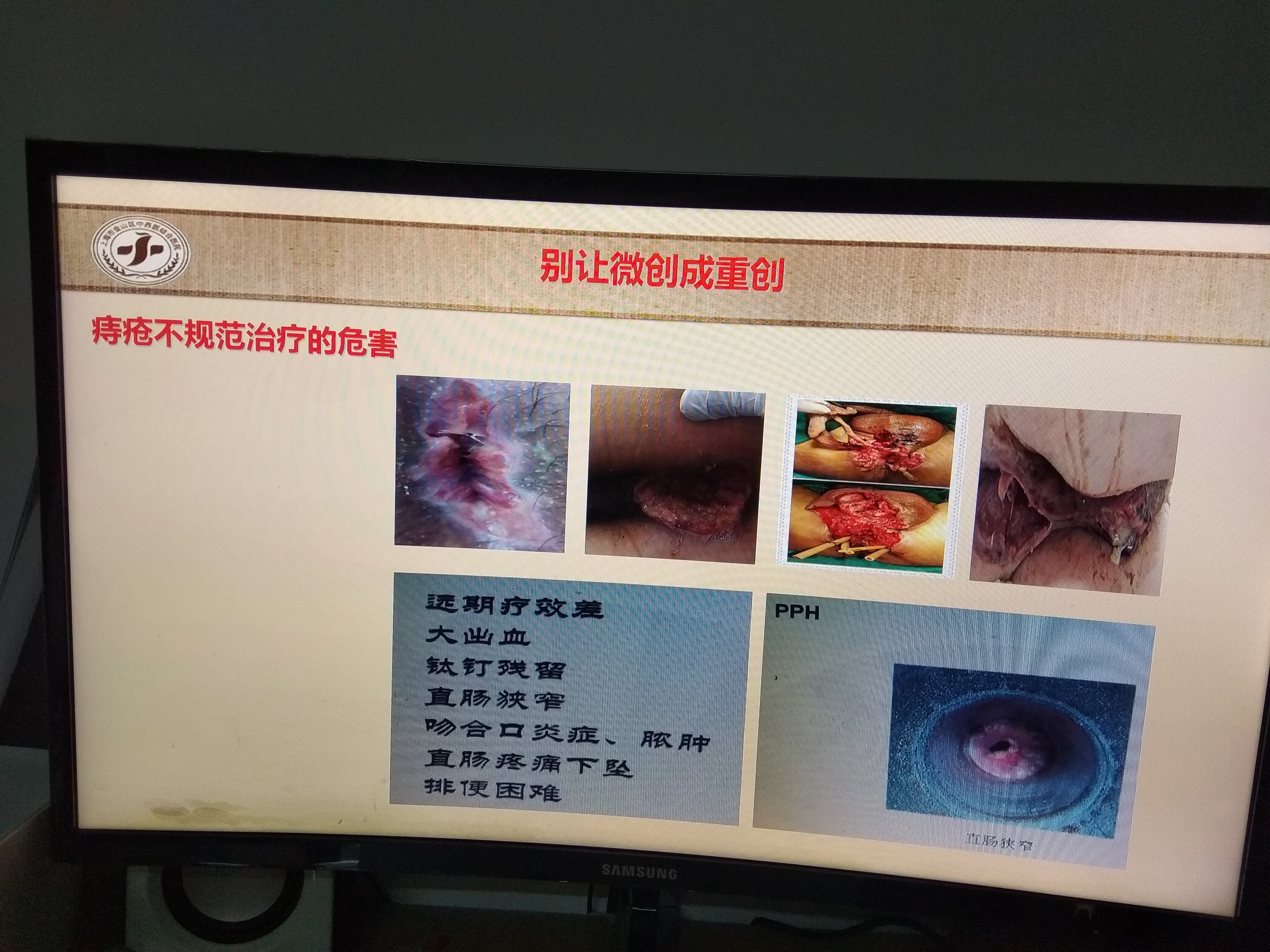 带你认识痔疮的微创手术!