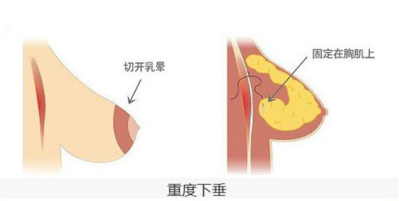 胸部正常大小,但下垂