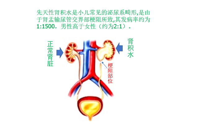 小儿肾积水的诊断和治疗