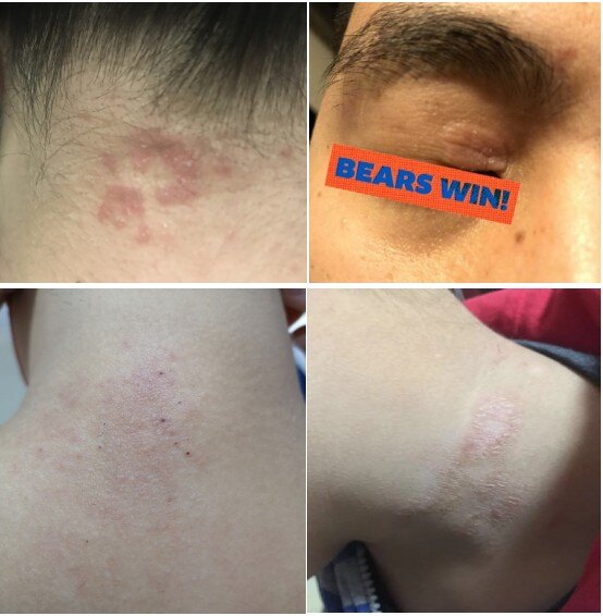 一些神经性皮炎案例分享