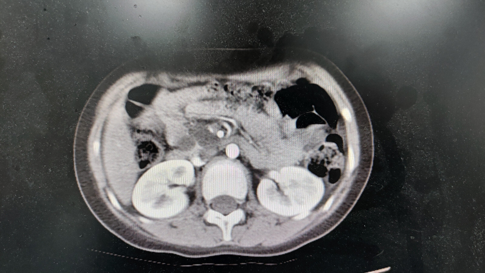 胰腺腺泡细胞囊腺瘤胰腺囊性肿瘤中的新异类