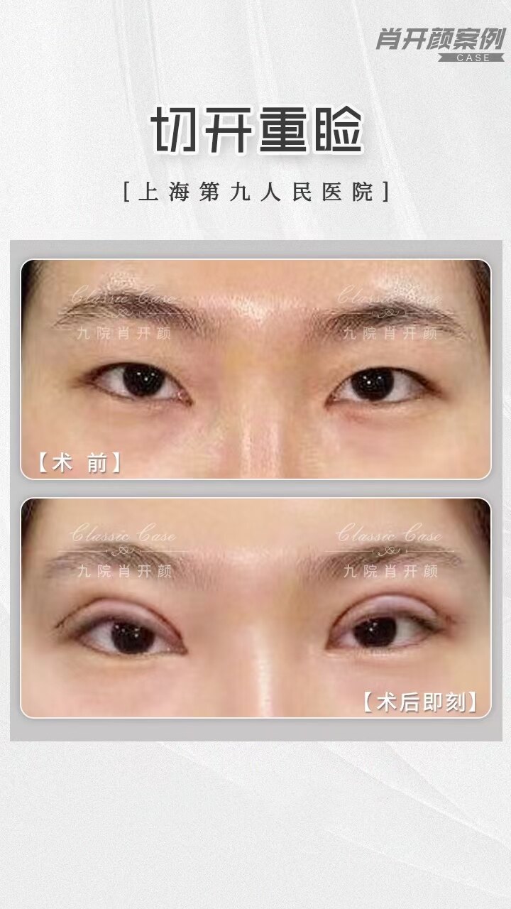 上海修复双眼皮的医生_全切双眼失败修复图_双眼皮修复价格