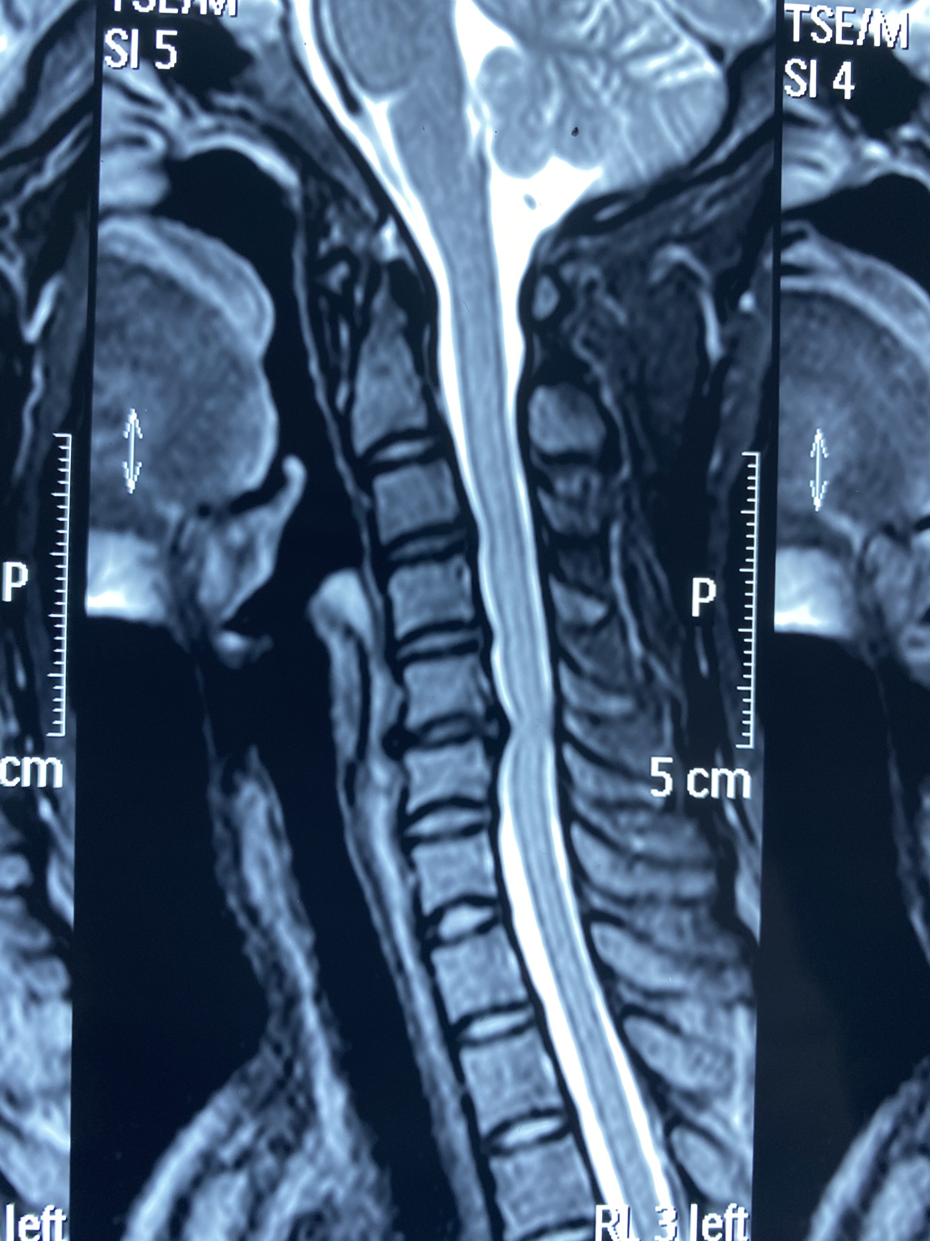 磁共振显示颈椎间盘突出压迫脊髓及硬膜囊