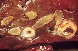 吃生鱼片患肝吸虫病_肝片形吸虫_淡水鱼虾中可能有什么寄生导致人患肝吸虫病