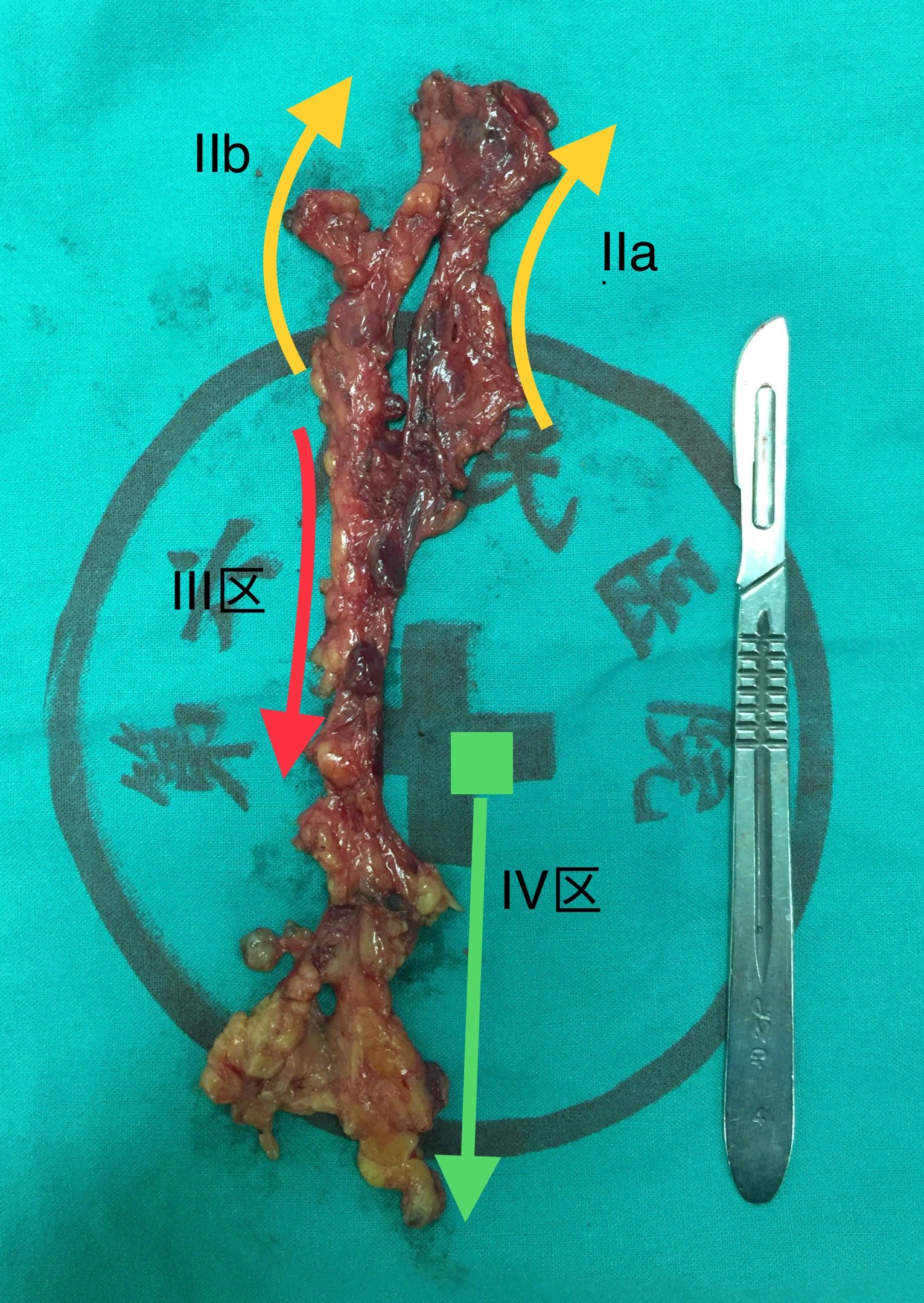 多灶微小甲状腺癌颈侧区淋巴结转移