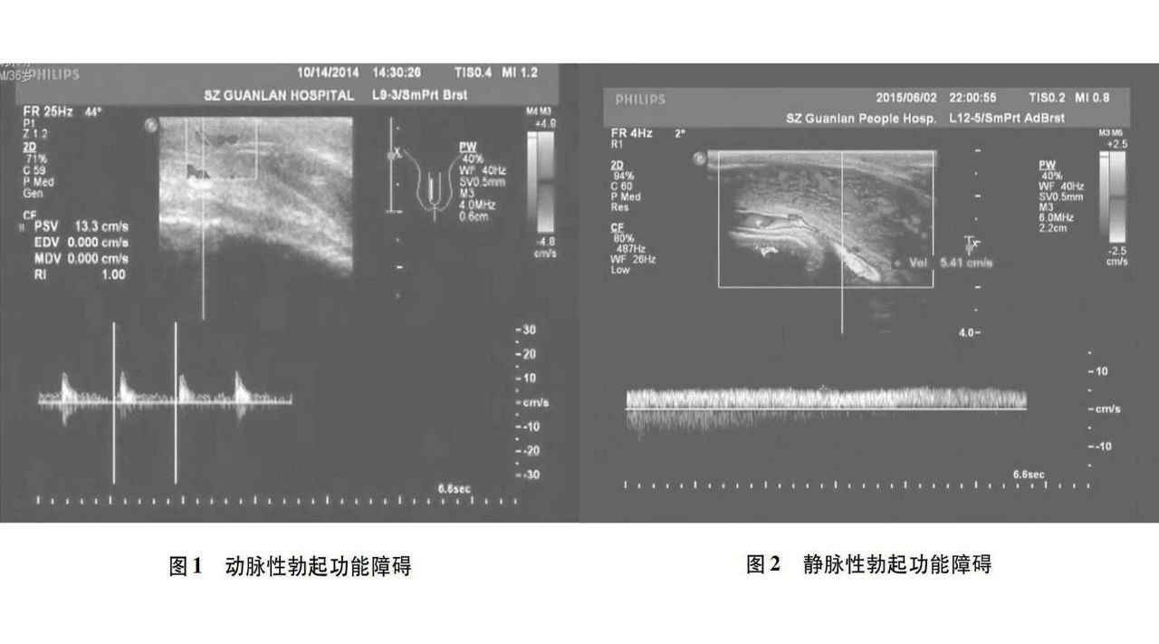 海绵体血管造影检查:海绵体造影用于检查静脉性勃起功能障碍,注射血管