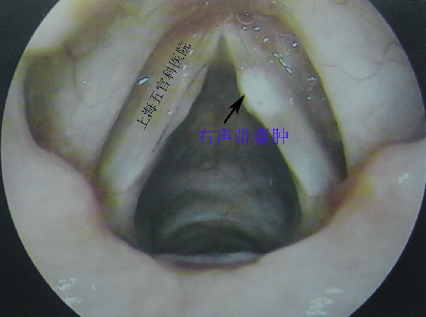 声带囊肿