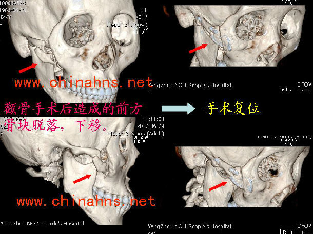 颧骨术后骨块下移的修复个人经验