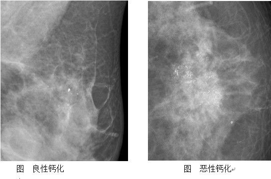 ★★★诊断篇005———什么是乳腺钙化