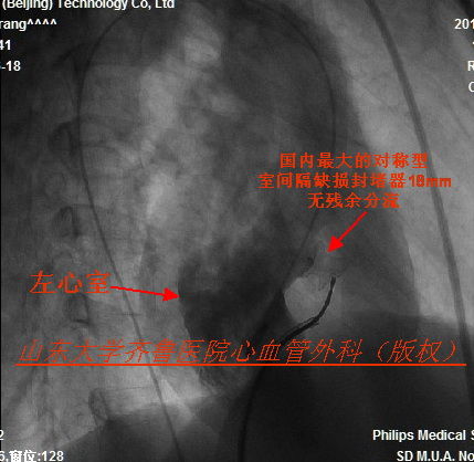 右位心室间隔缺损的介入封堵治疗