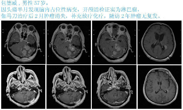 通俗讲解伽玛刀原理
