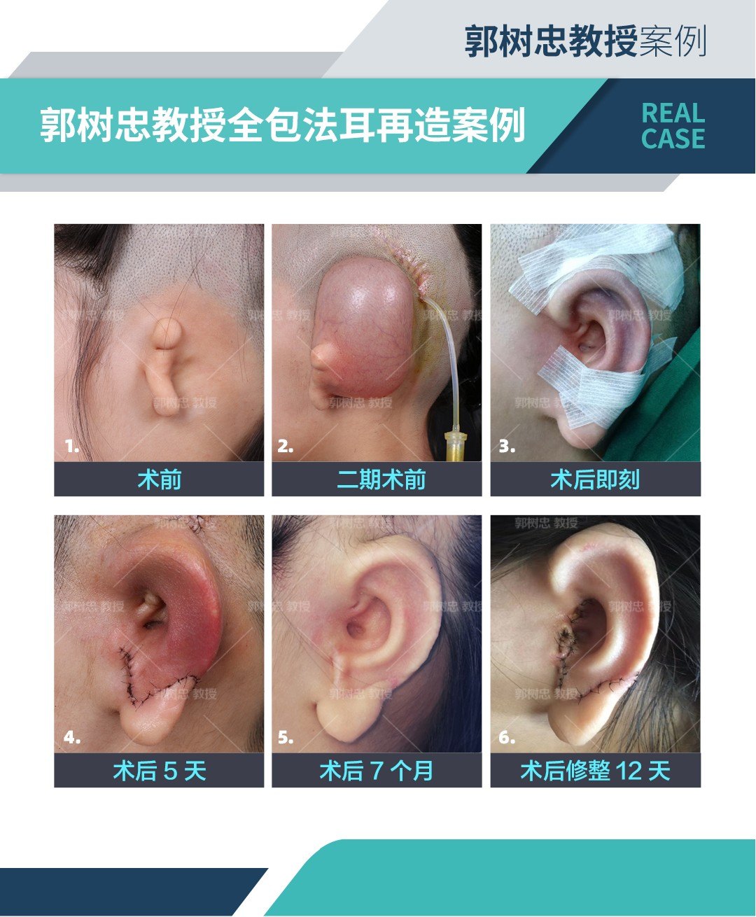 耳再造手术的细节(八)耳再造手术拆线的时间为什么要慢