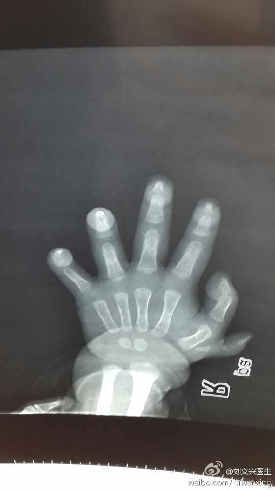 六指畸形手术治疗