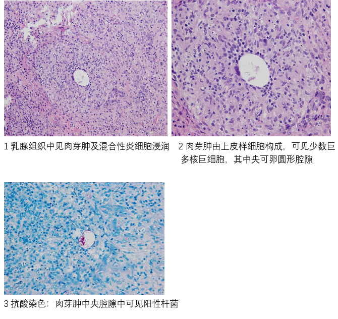 肉芽肿性小叶性乳腺炎glm的病理诊断(作者:杜玉堂)