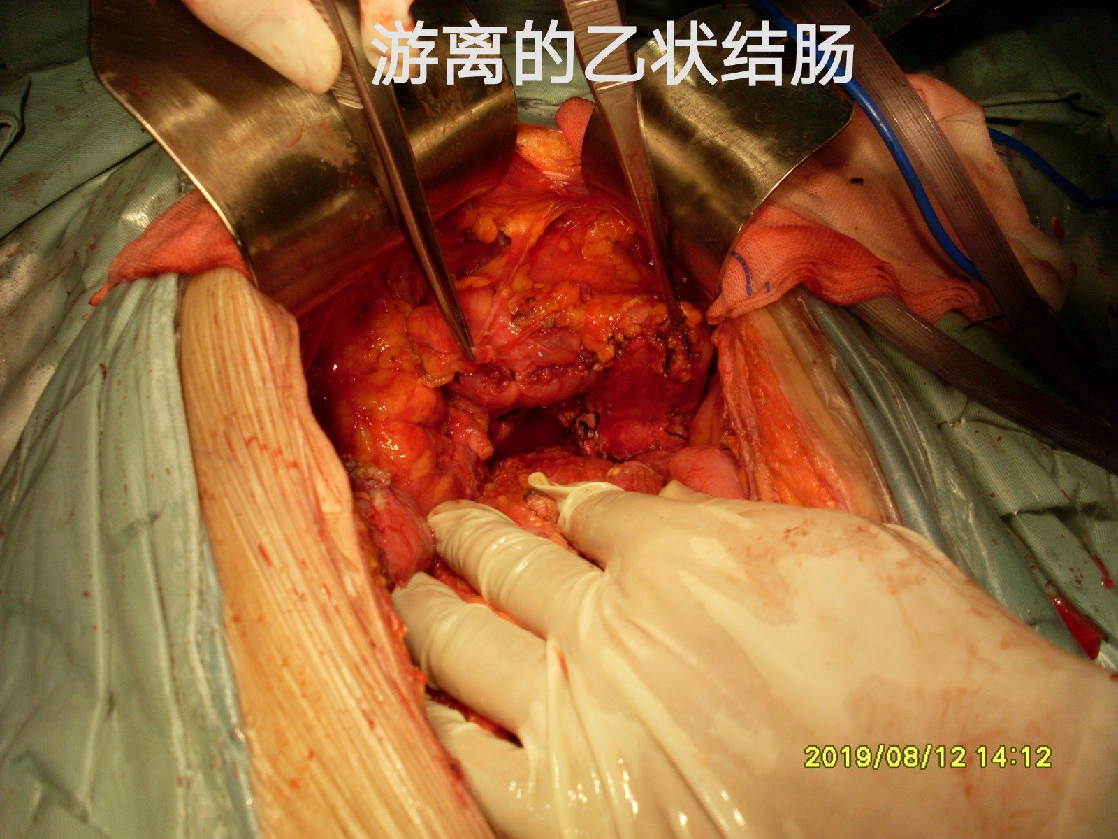 7 手术过程:无腹水,小肠管与右侧腹壁粘连,原右侧切口长约5cm,裂开至