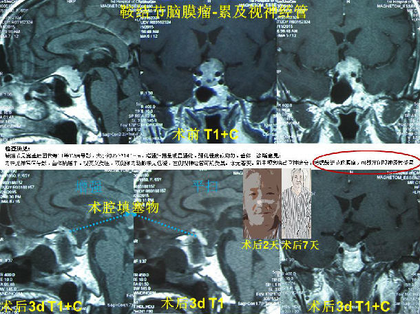 脑膜瘤的生物学行为与治疗策略 复杂脑膜瘤的微创手术治疗） 脑膜瘤 治疗方法 治疗方式 好大夫在线